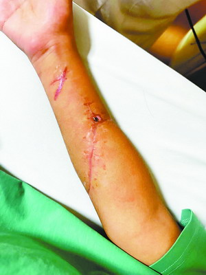 12岁男孩和同学起争执 狠砸玻璃出气手臂严重断裂